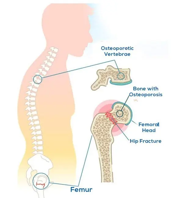 Overview of Chronic Back Pain