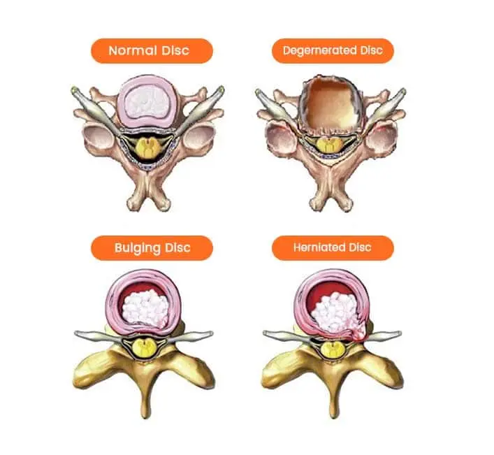 What is a Slipped Disc?